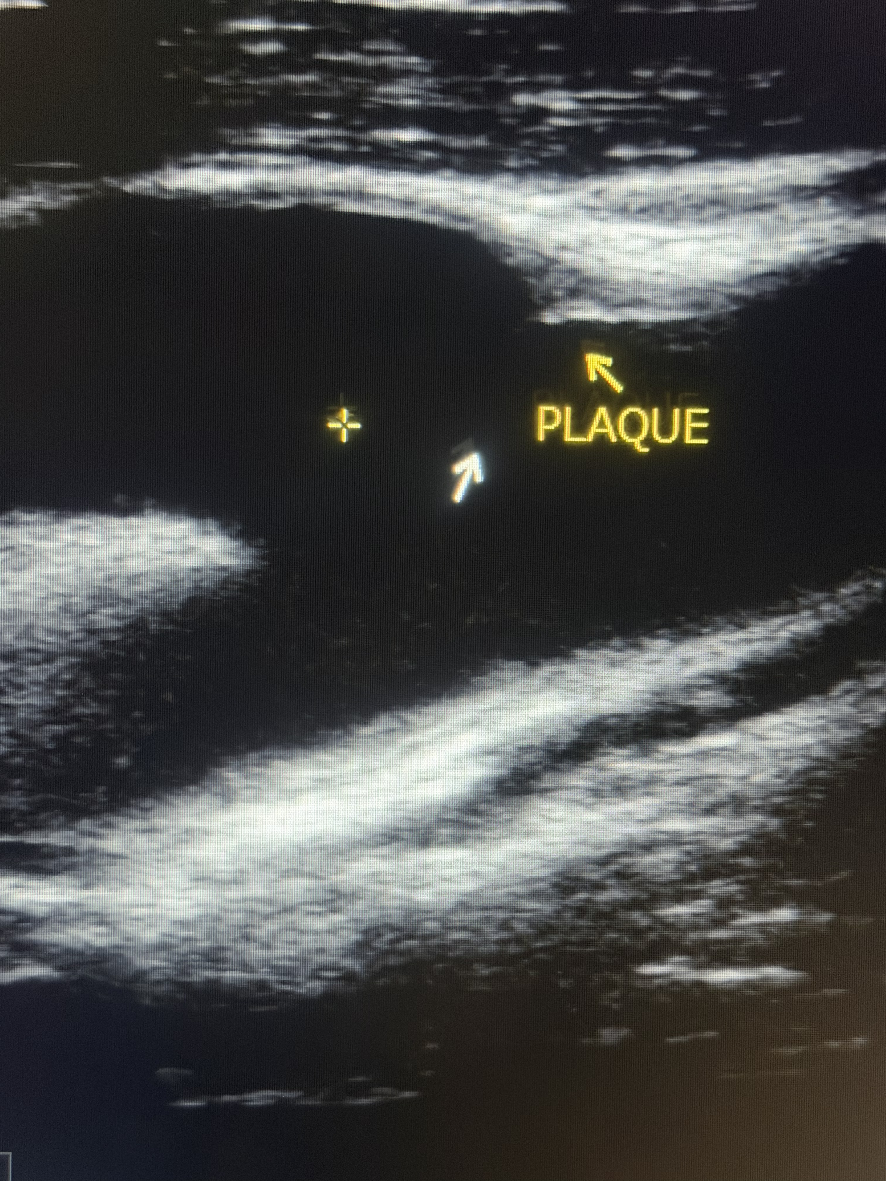 In-office carotid ultrasound — direct measurement of the artery wall